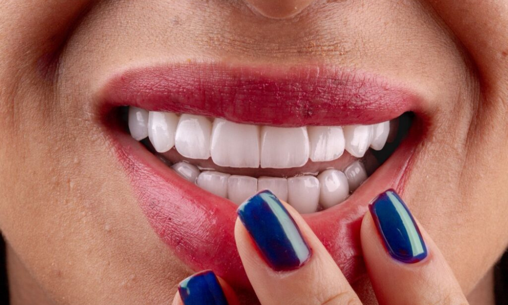 clareamento dental em Porto Alegre