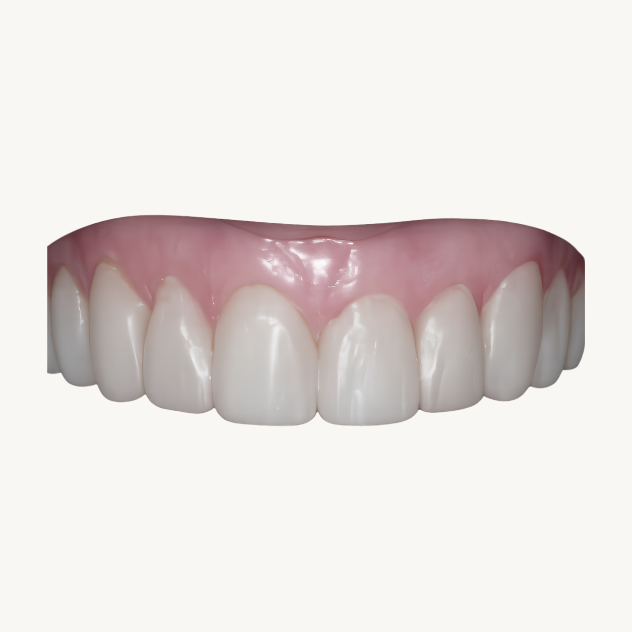 Lente dentais de resina - dr fabio braga - dentista porto alegre RS